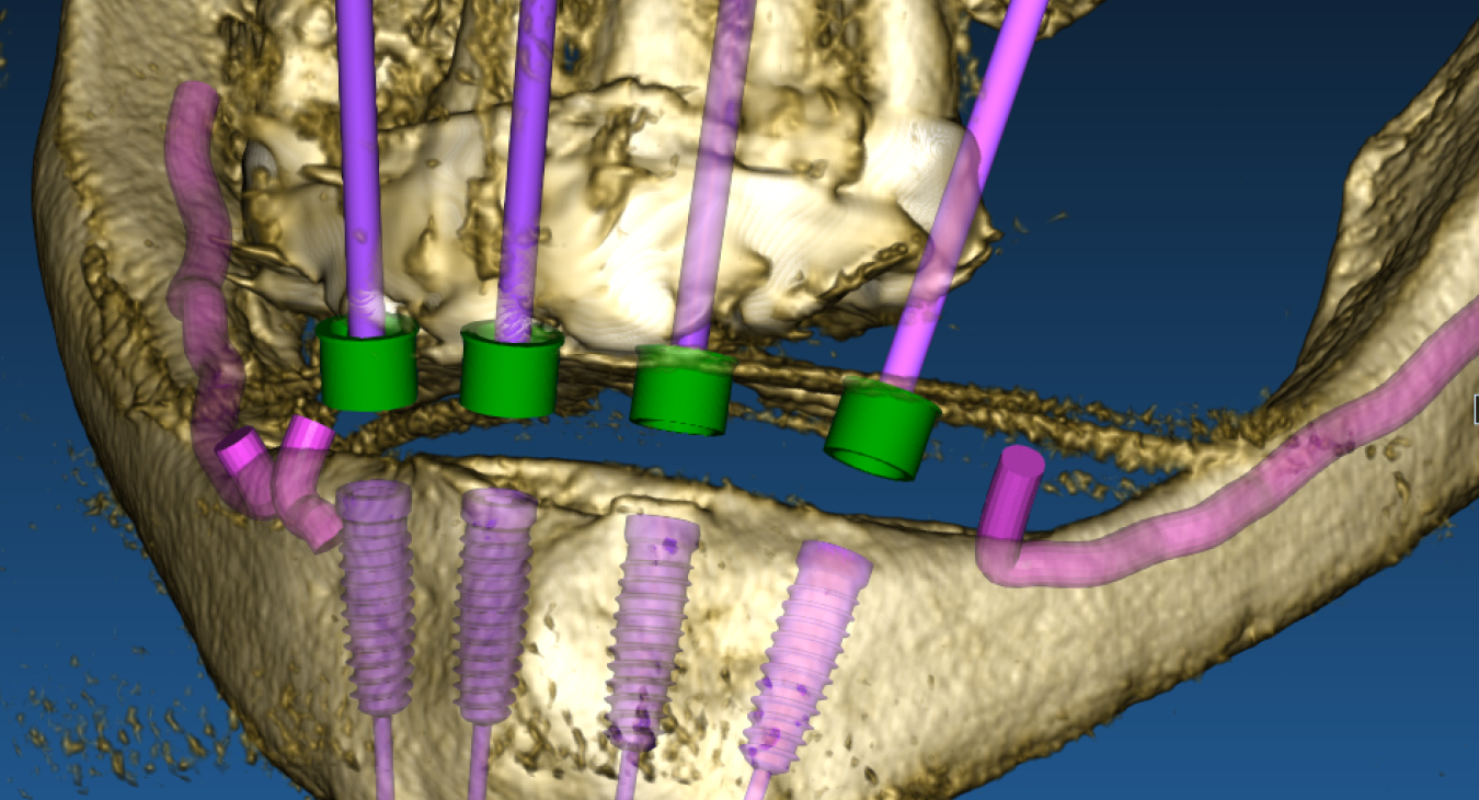 Chirurgia Implantare Guidata