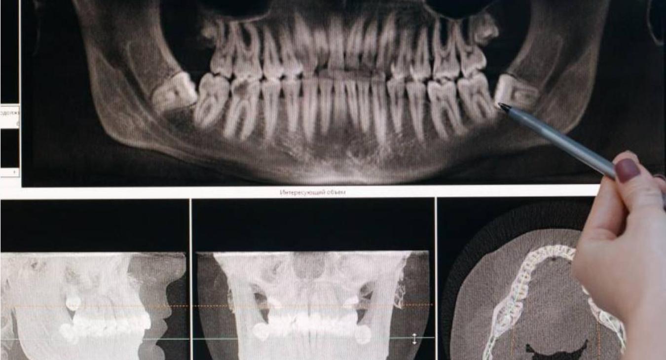 Tomografia computerizzata (Cone Beam Computed Tomography CBCT)